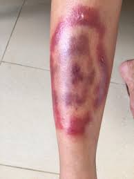 Erysipelas - Hình ảnh minh họa